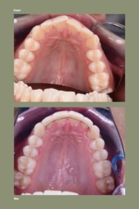 Afbeelding van de boven- en ondertanden van een patiënt, voor en na cosmetisch herstel en tanden bleken, illustrerend de verbeterde tandstructuur en esthetiek na behandeling bij VLIJT Tandartsen.