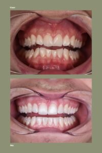 Voor en na foto's van tanden van een jonge patiënt met slijtage, illustrerend de resultaten van tandheelkundige behandelingen zoals aligners en tanden bleken.