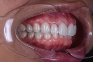Patiënt met porseleinen facings en heldere glimlach, zichtbaar in de behandelstoel met een mondopenhouder, illustrerend de cosmetische tandheelkunde bij VLIJT Tandartsen.