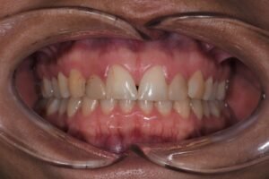 Gezicht van een gebit met zichtbare voortanden en kiezen, tonen van onregelmatige tandvormen en kleurvariaties, relevant voor cosmetische tandheelkunde en porseleinen facings bij VLIJT Tandartsen.