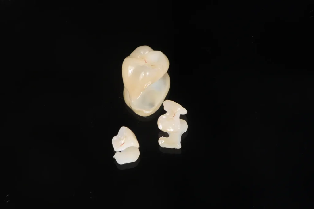 Voorbeeld van porseleinen restauratie met natuurlijke kleur en glans