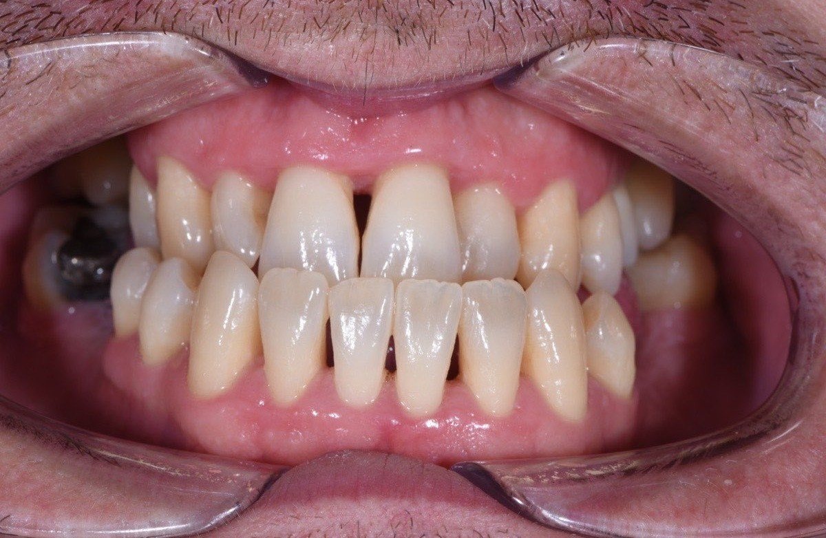 Healthy teeth after periodontitis treatment - frontal view with clean gums after teeth cleaning at dental hygienist Eindhoven