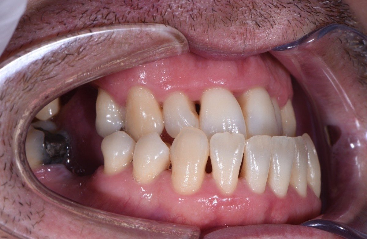 Result after periodontal protocol - left side view with healthy gums after calculus removal Eindhoven