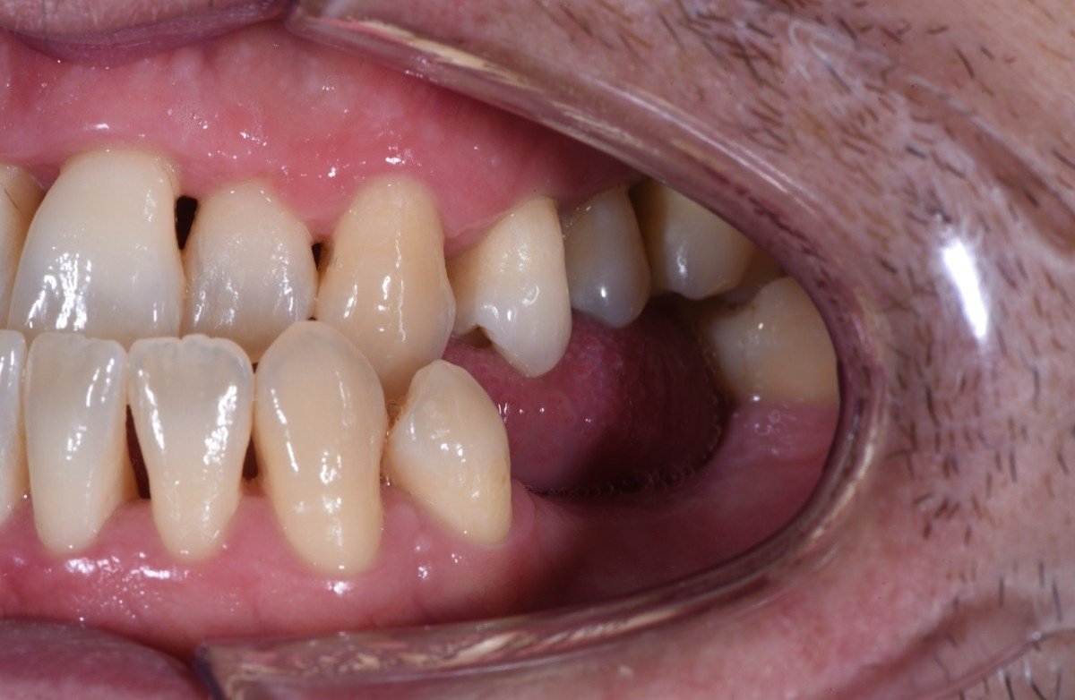 Successfully treated periodontitis - side view after intensive teeth cleaning VLIJT Tandartsen Eindhoven