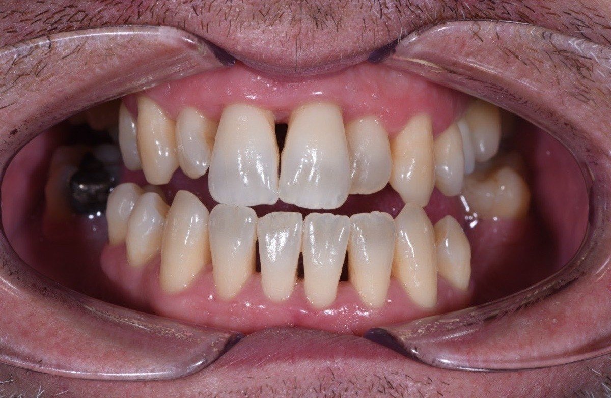 Healthy gums after periodontitis treatment - detail after teeth cleaning dental hygienist VLIJT Eindhoven