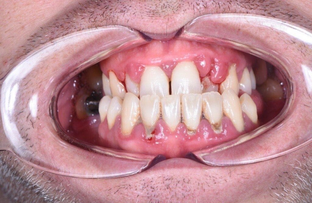 Dental hygienist in Eindhoven, professional teeth cleaning at VLIJT Tandartsen