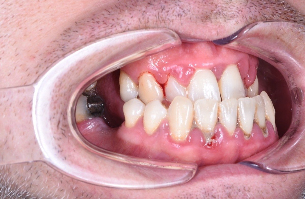 Gum inflammation before periodontal protocol treatment - left side view with calculus and gingivitis