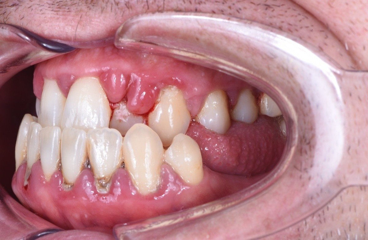 Severe periodontitis before treatment - right side view with swollen gums and plaque accumulation