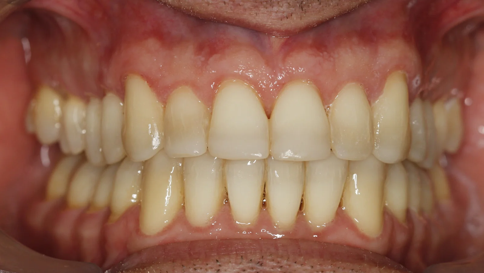 Final result after multidisciplinary tooth wear treatment at VLIJT Tandartsen Eindhoven