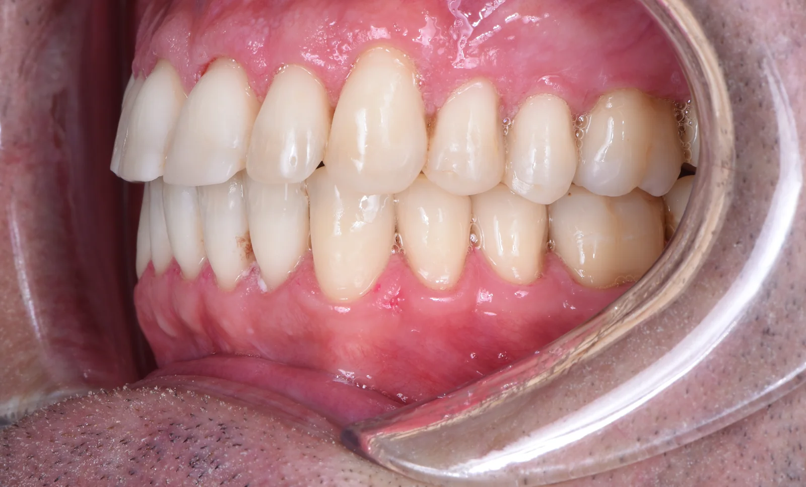 Final result tooth wear treatment lateral left VLIJT