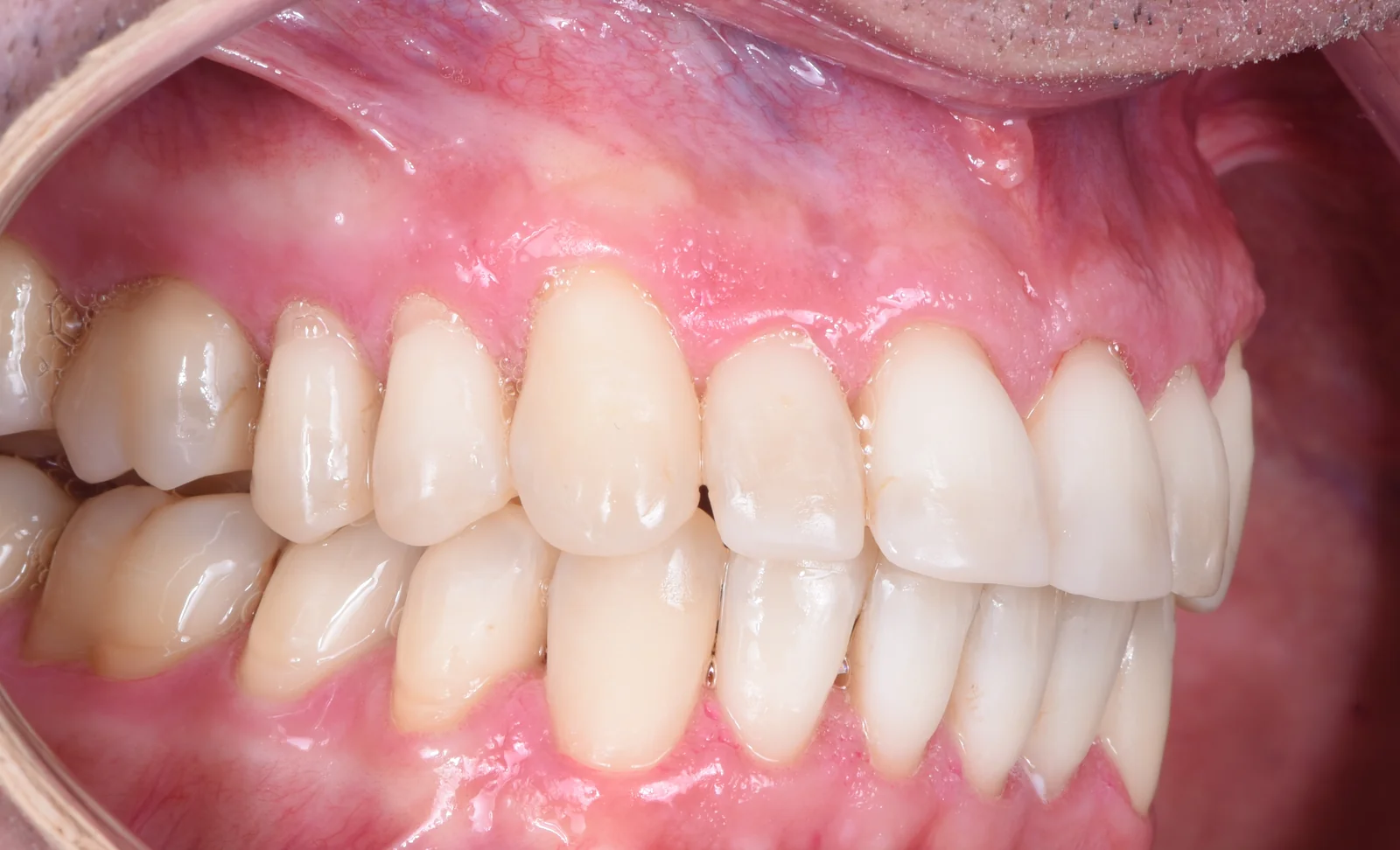 Final result tooth wear treatment lateral right VLIJT
