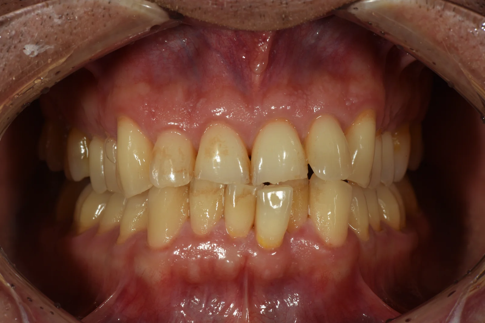 Patient portrait after multidisciplinary tooth wear treatment VLIJT Eindhoven photo 1
