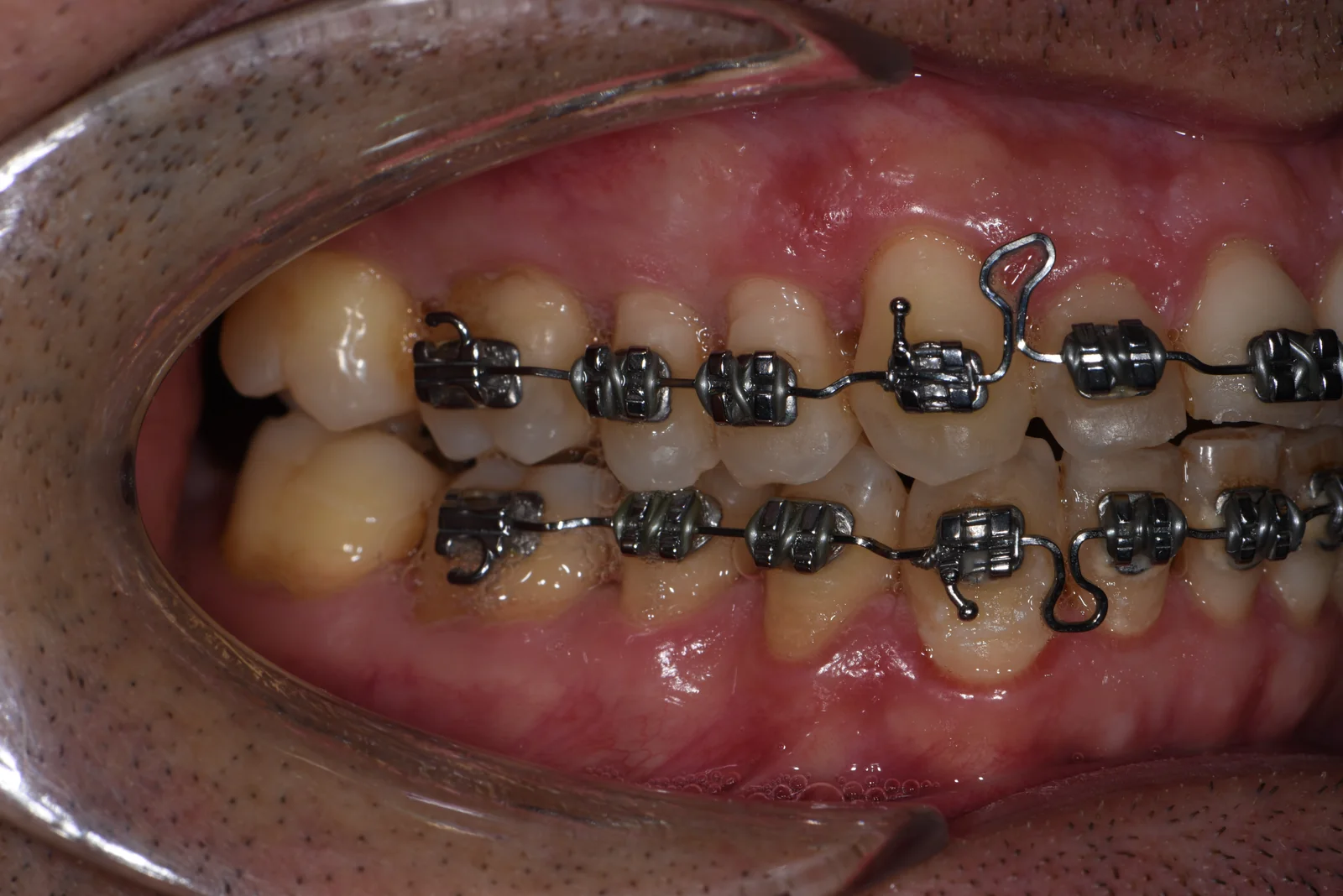 Patient portrait after multidisciplinary tooth wear treatment VLIJT Eindhoven photo 2