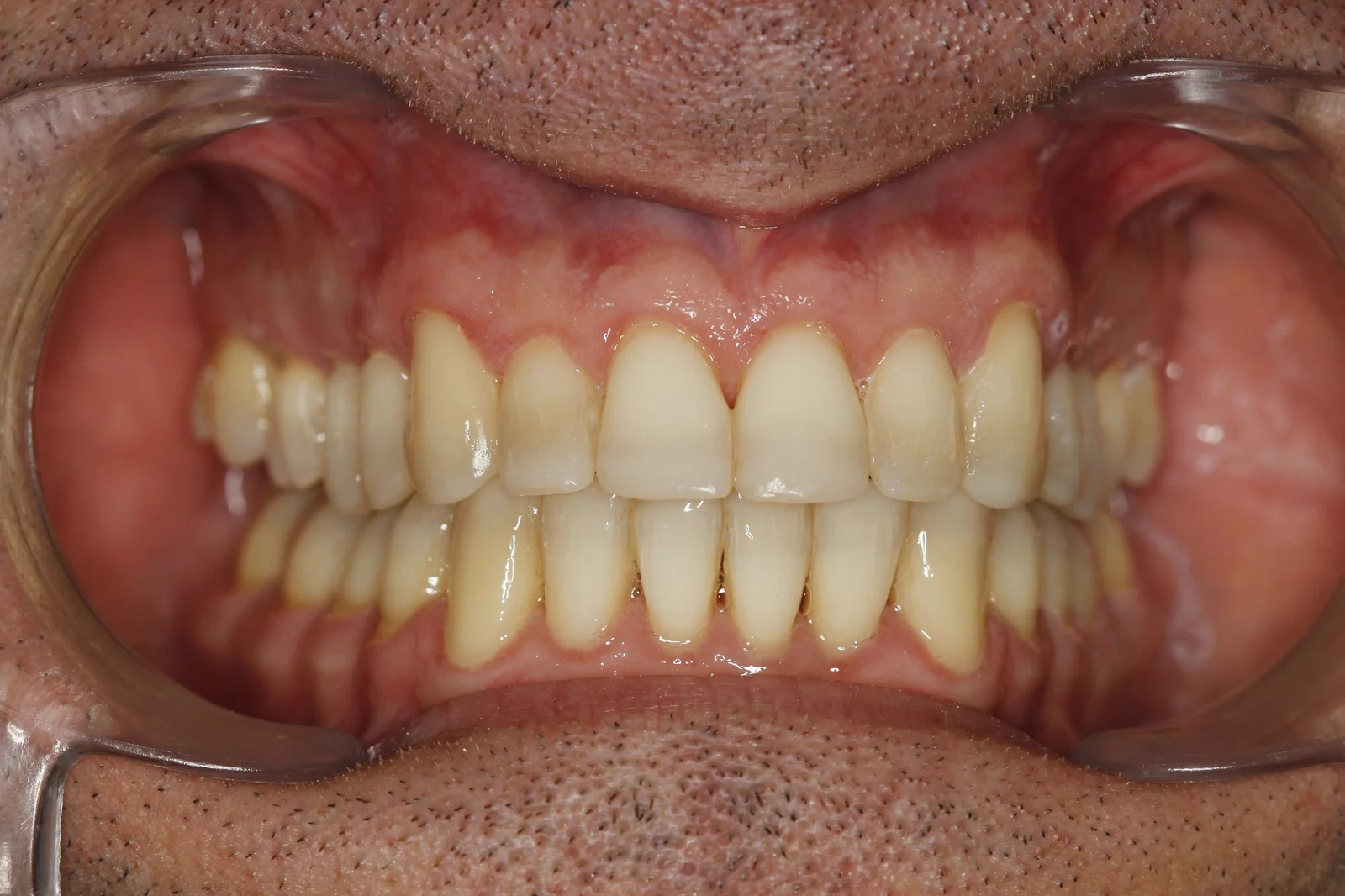 Patient portrait after multidisciplinary tooth wear treatment VLIJT Eindhoven photo 3
