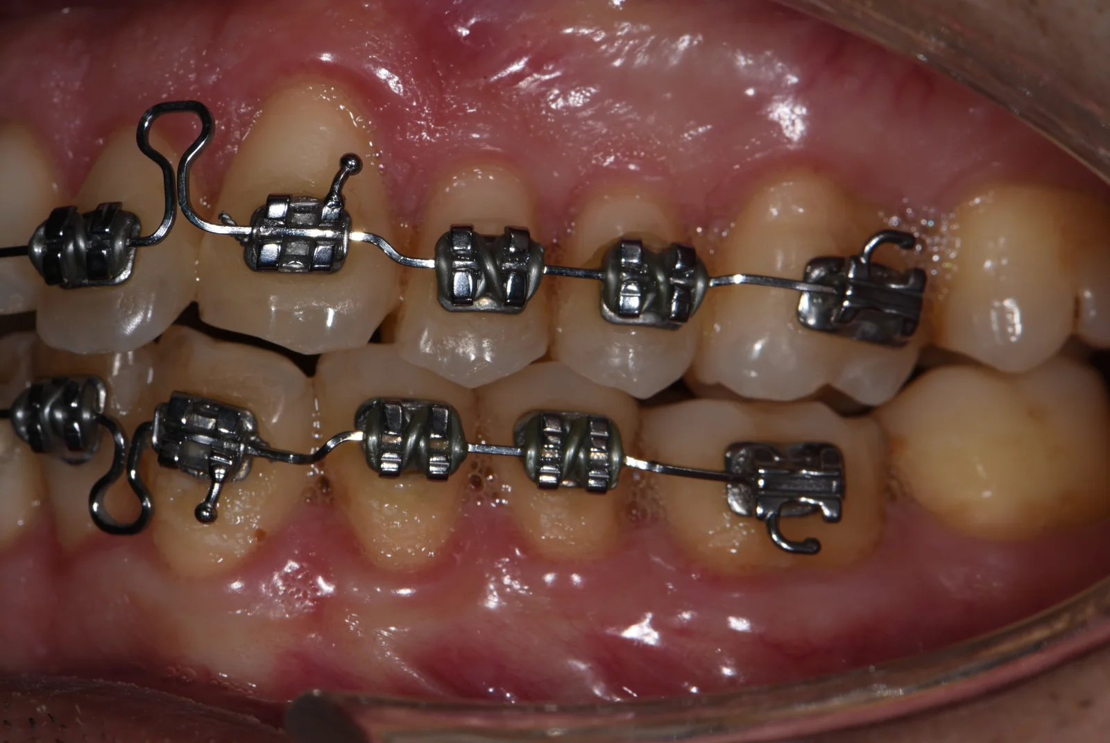 Orthodontisch traject beugel links gebitsslijtage VLIJT