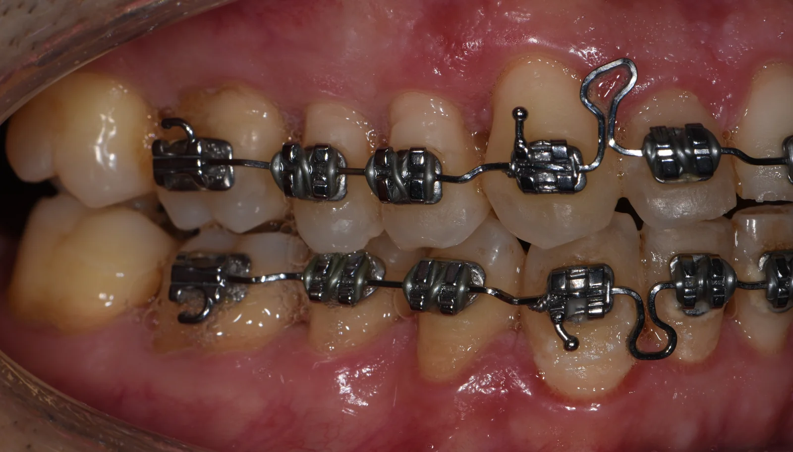 Orthodontisch traject beugel rechts gebitsslijtage VLIJT