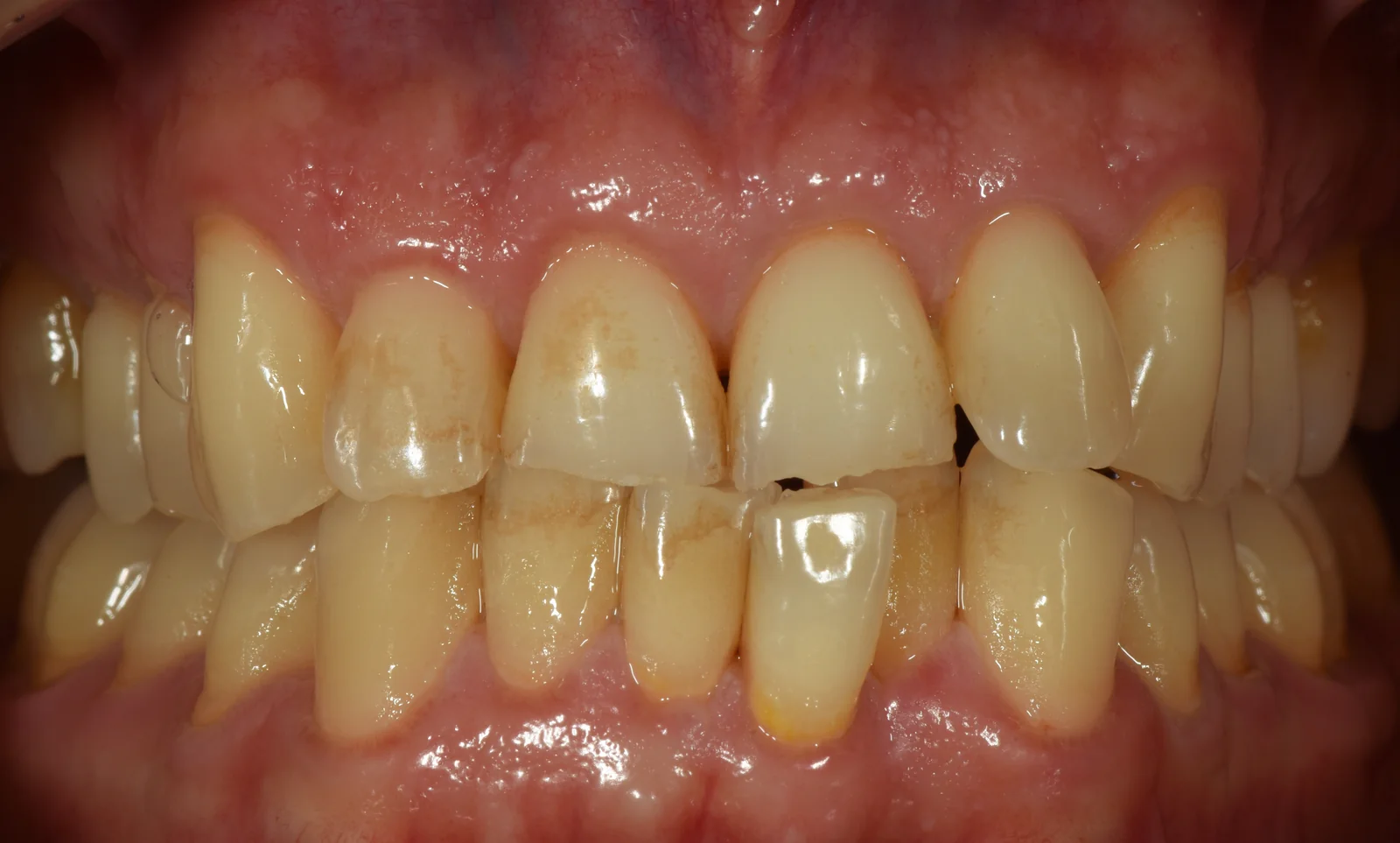 Initial situation tooth wear frontal view VLIJT Eindhoven