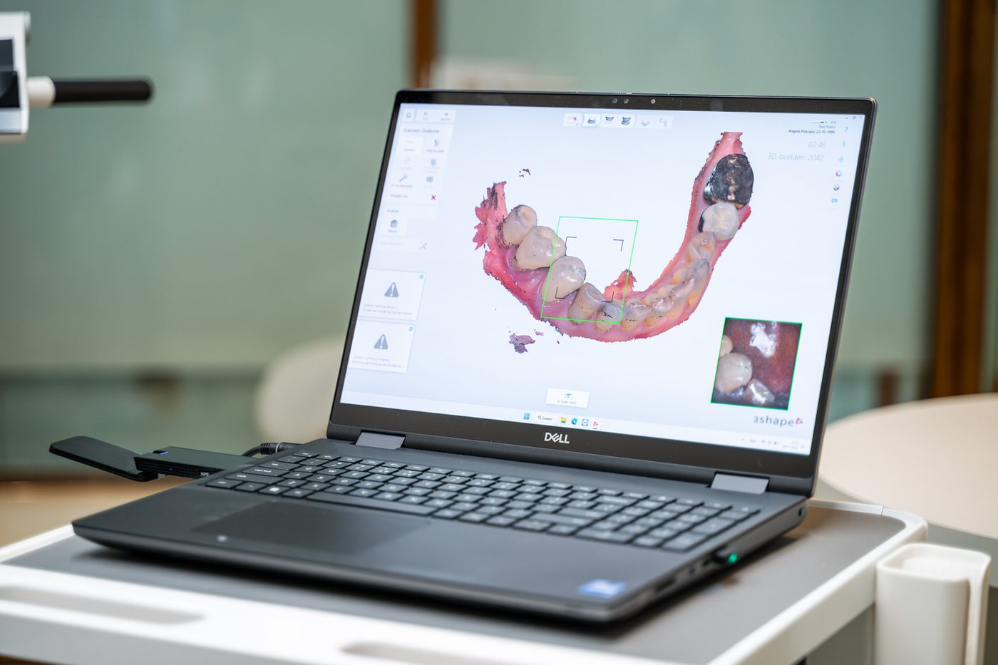 3D scan of the jaw before placing a dental implant at VLIJT in Eindhoven