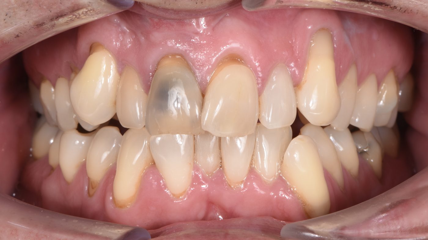 The front tooth at the first visit