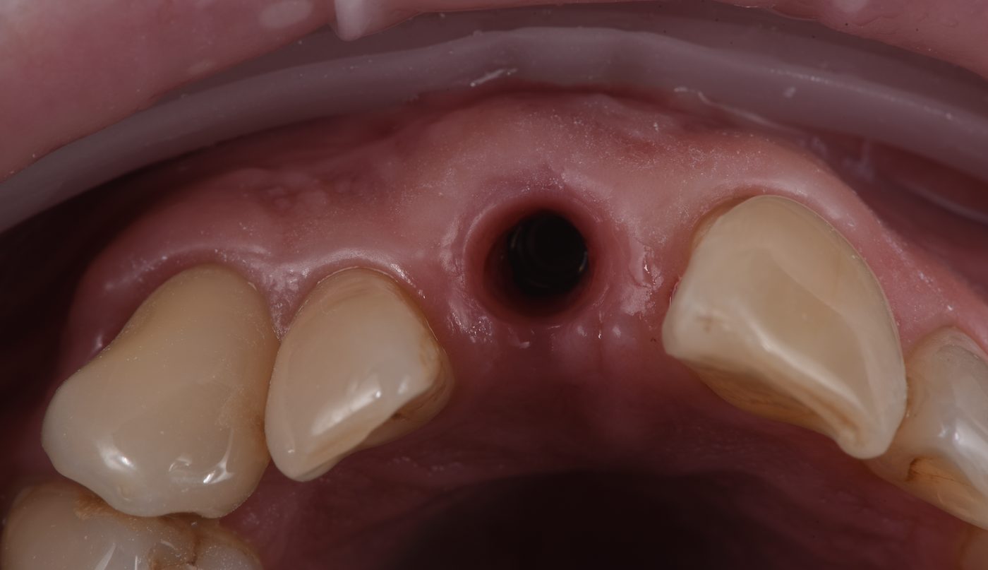 The implant has been placed and has integrated