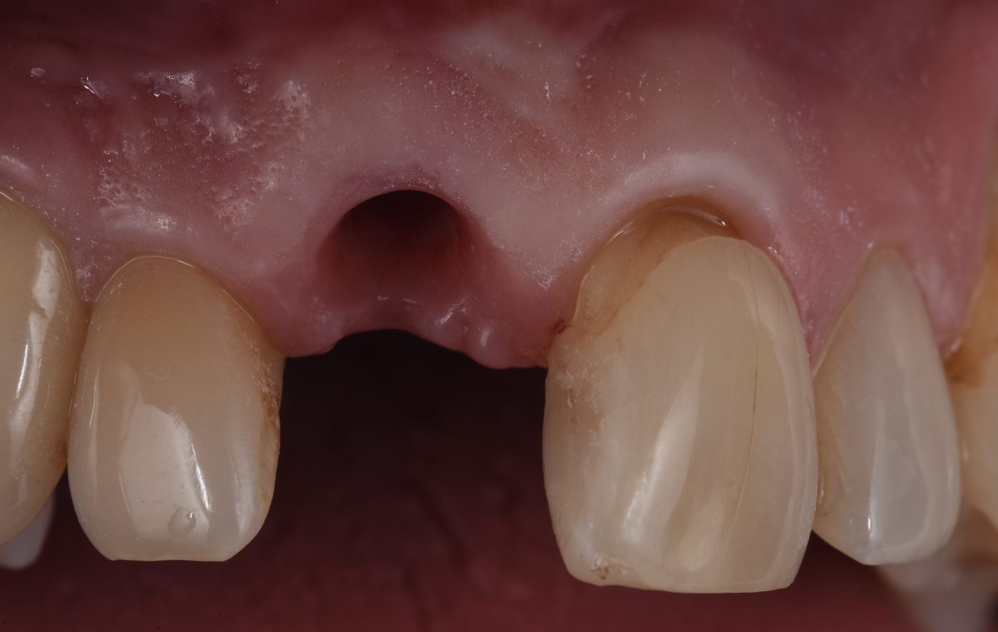 The gum around the implant, ready for the crown.