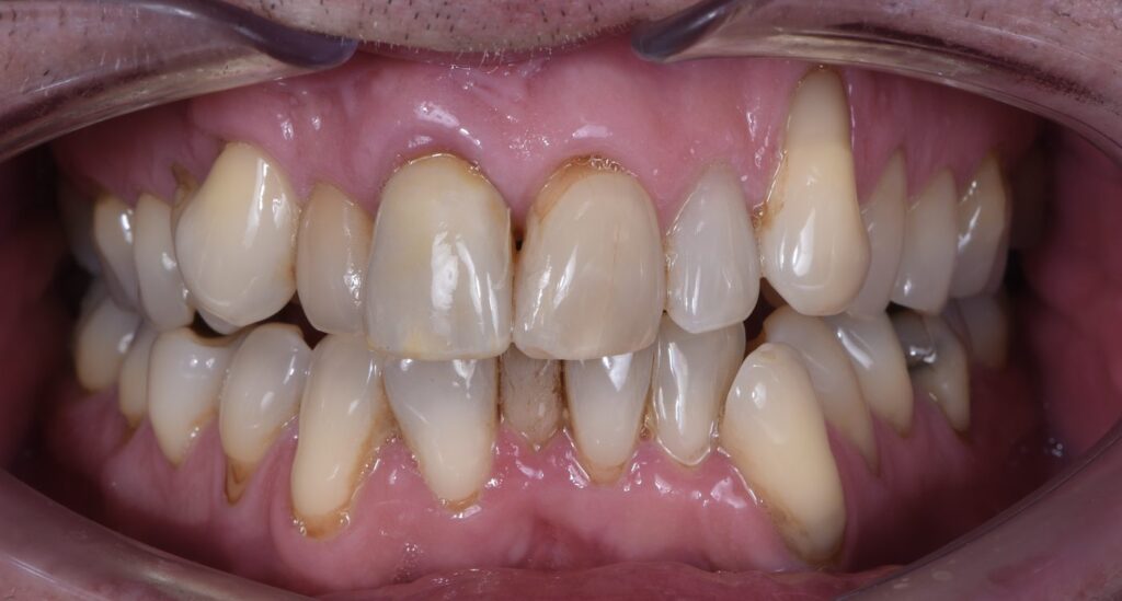 Result: crown on a front tooth implant, matched to the neighbouring teeth